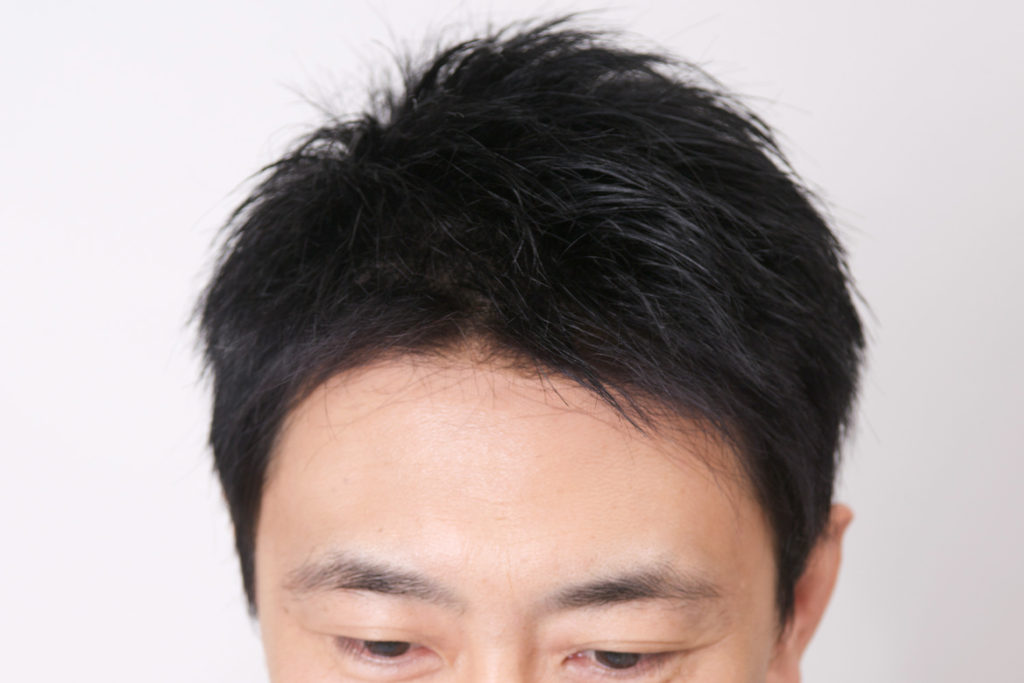 ウィッグ男性の生え際写真